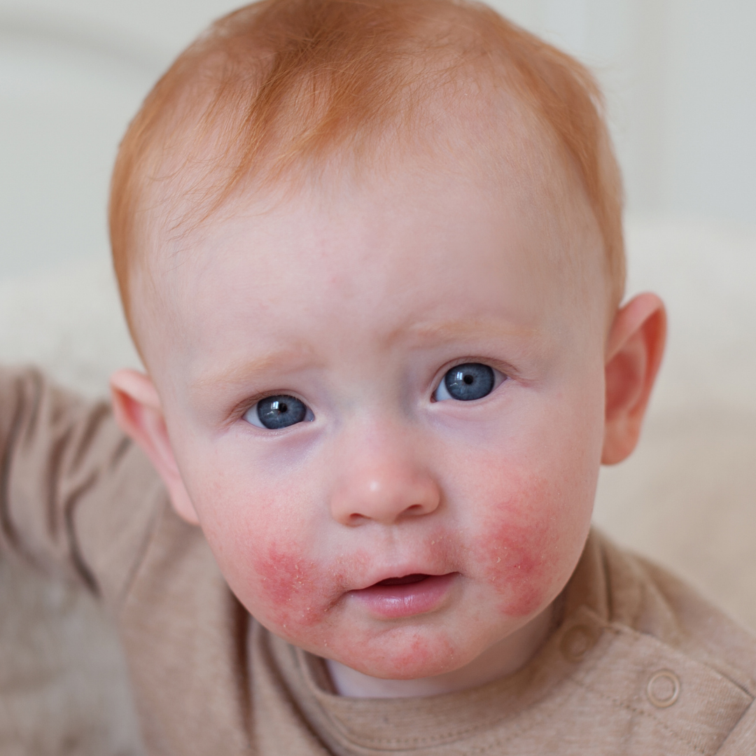 Lee más sobre el artículo La Microbiota intestinal puede afectar en la dermatitis atópica infantil