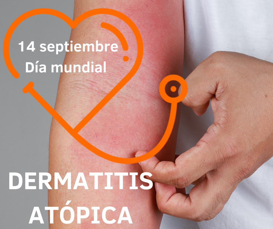 Lee más sobre el artículo Los cinco escalones en el tratamiento de la Dermatitis Atópica